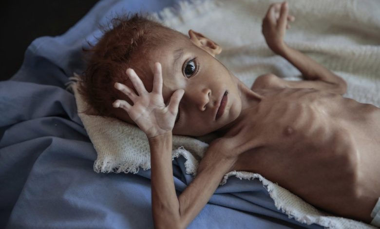 صورة سوء التغذية يهدد 60 ألف طفل يمني بالموت