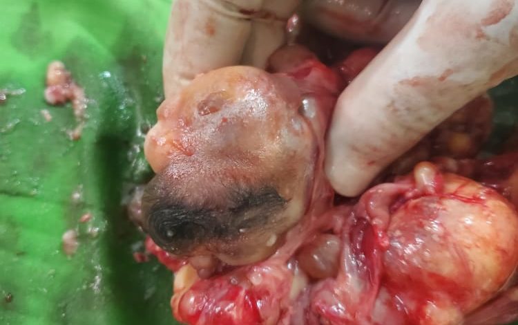 صورة بالصور.. نجاح عملية نادرة وغير مسبوقة لطفلة توأمها داخلها في أحد مشافي حضرموت