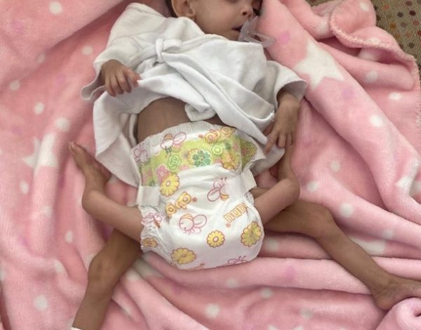 صورة طاقم طبي سعودي يجري عملية فصل توأم طفيلي يمني