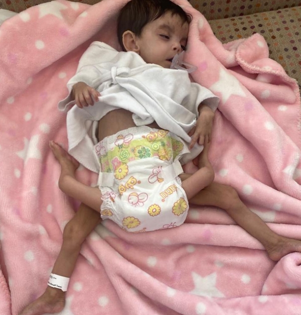 طاقم طبي سعودي يجري عملية فصل توأم طفيلي يمني