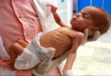 صورة المركزي للإحصاء يكشف عن تعرض نصف أطفال اليمن لسوء التغذية والتقزم