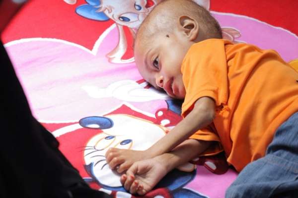 صورة الصحة العالمية: مليونا طفل دون سن الخامسة في اليمن يعانون من الهزال
