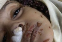 صورة جريمة بشعة تهز صنعاء .. زوجة أب تعذب طفلة حتى الموت