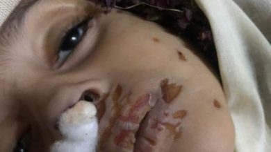 صورة جريمة بشعة تهز صنعاء .. زوجة أب تعذب طفلة حتى الموت