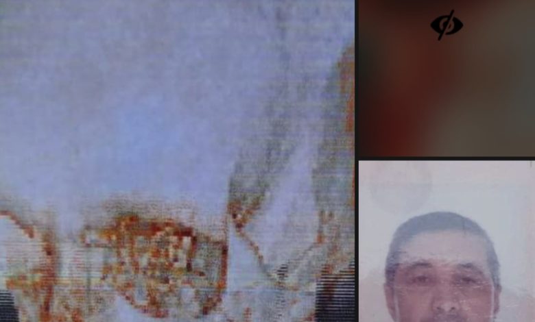 صورة نجاح أول عملية جراحية نوعية في الدماغ بأحد مستشفيات المهرة