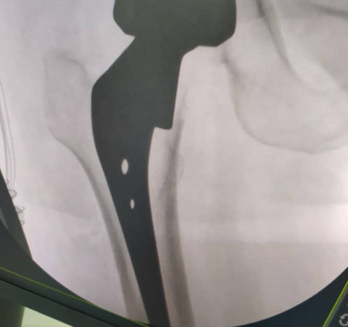 صورة لأول مرة في المحافظة…كادر طبي في شبوة ينجح في زراعة مفصل ورك صناعي لامرأة مسنة